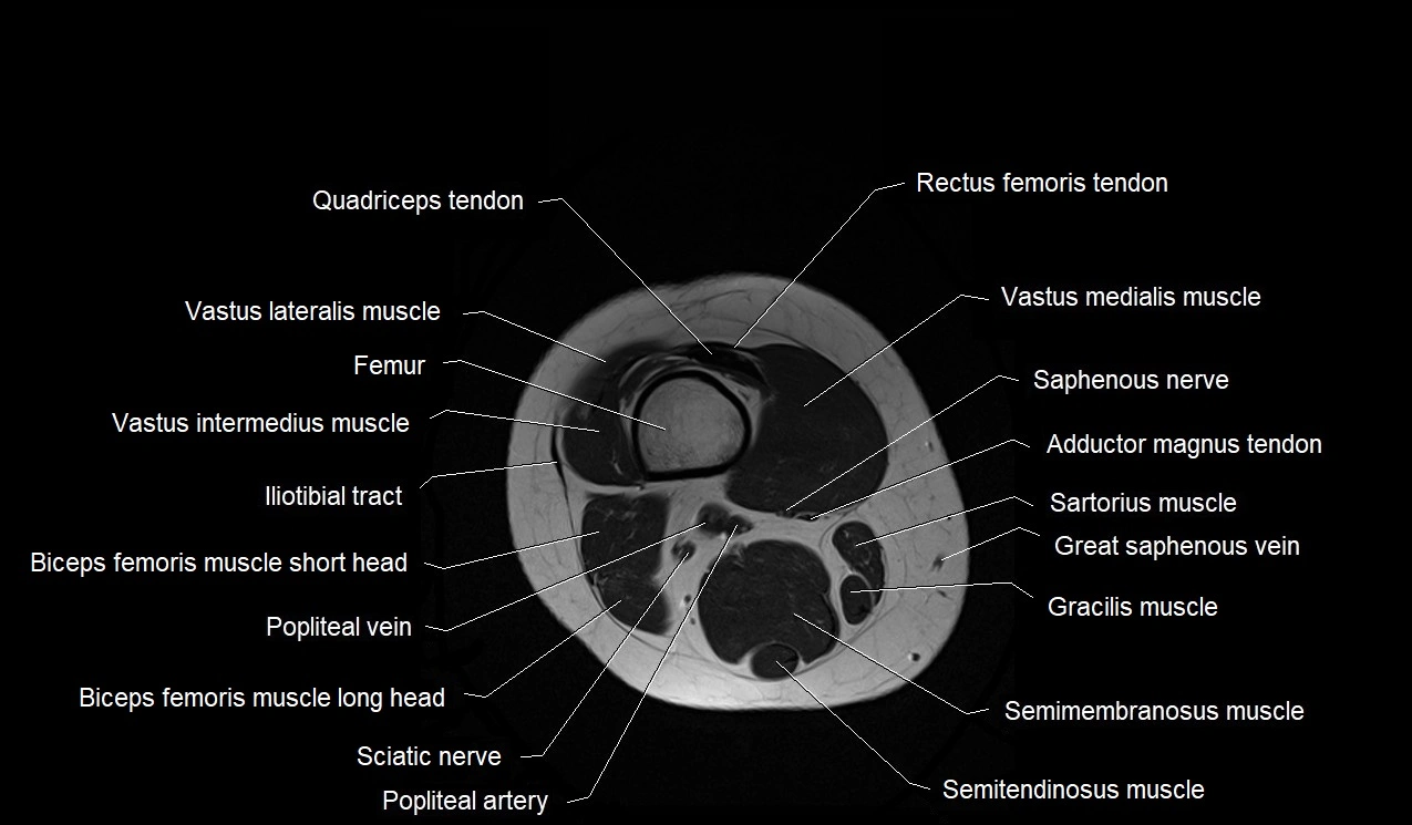 MRI thigh cross sectional anatomy image 48.webp